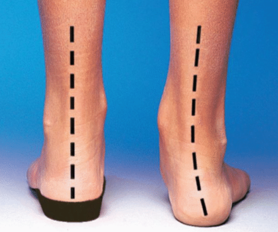 Bio feet alignment